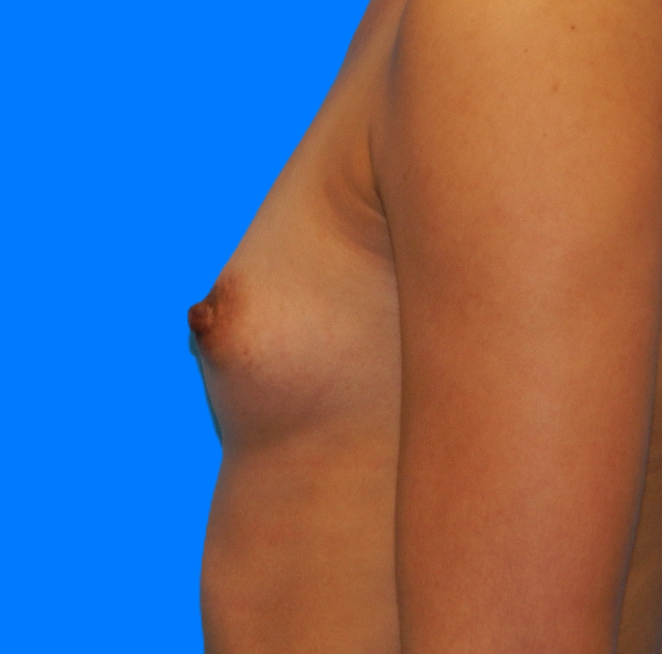 Before Image: Patient Case #0176 - left-side