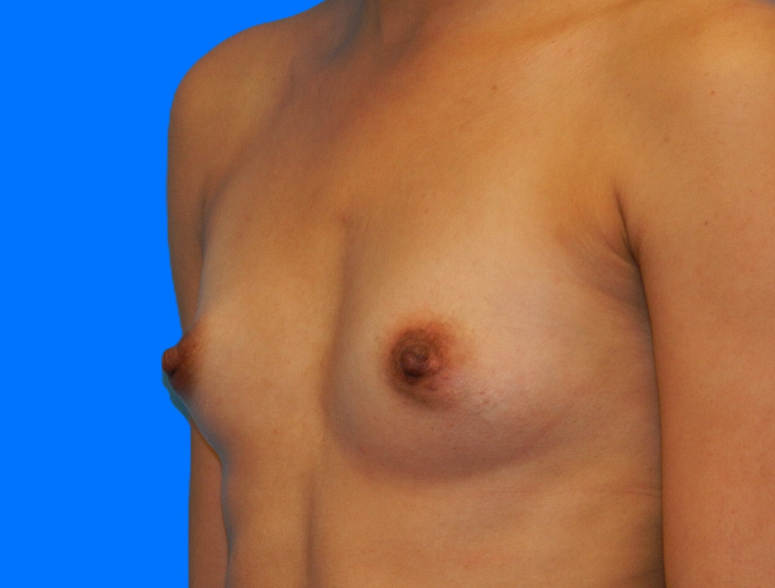 Before Image: Patient Case #0176 - left-front-oblique
