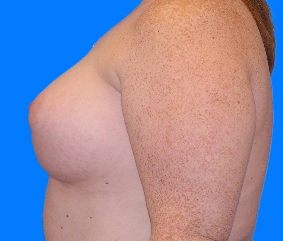 After Image: Patient Case #0177 - left-side