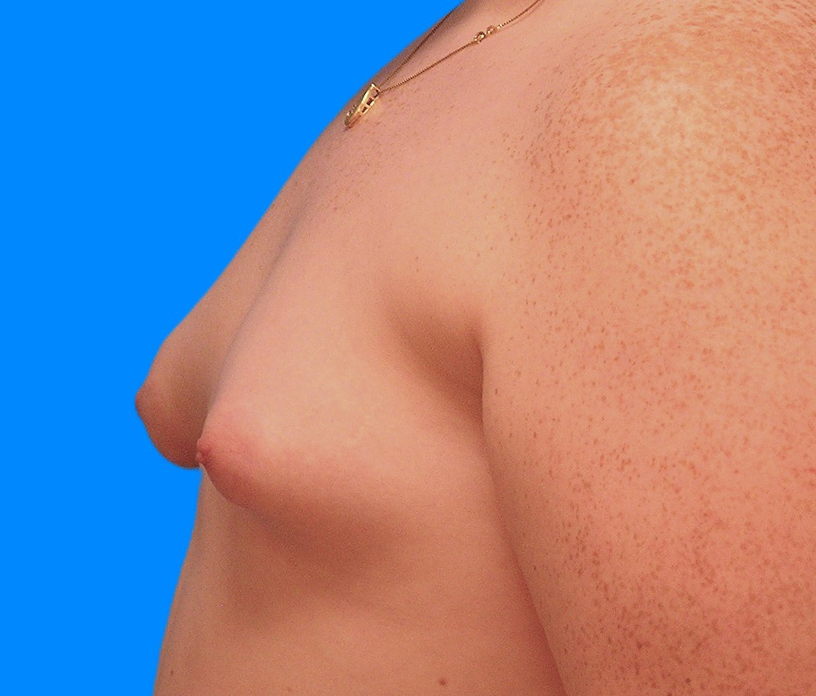 Before Image: Patient Case #0177 - left-side