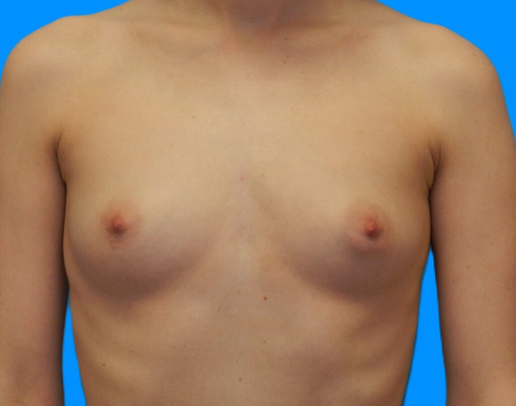 Before Image: Patient Case #0178 - front