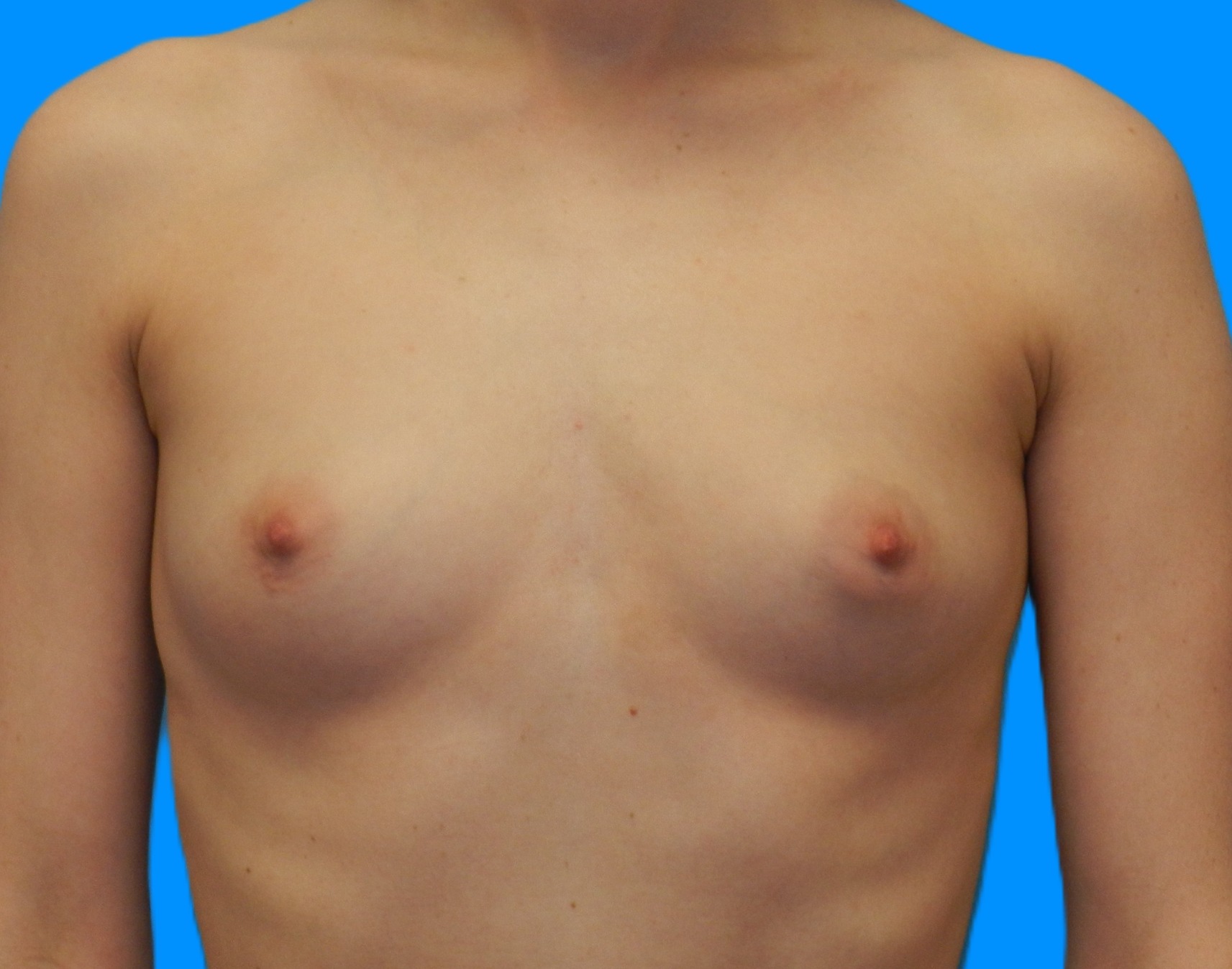 Before Image: Patient Case #0178 - front