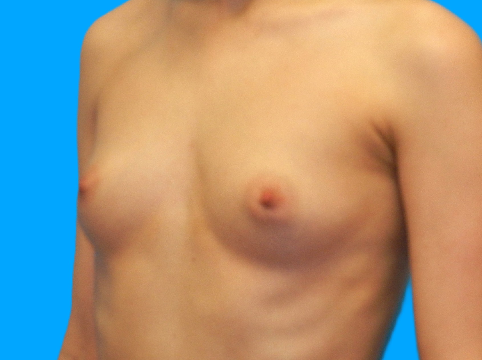 Before Image: Patient Case #0178 - left-front-oblique