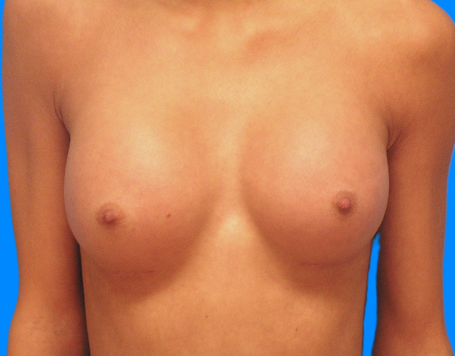 After Image: Patient Case #0179 - front