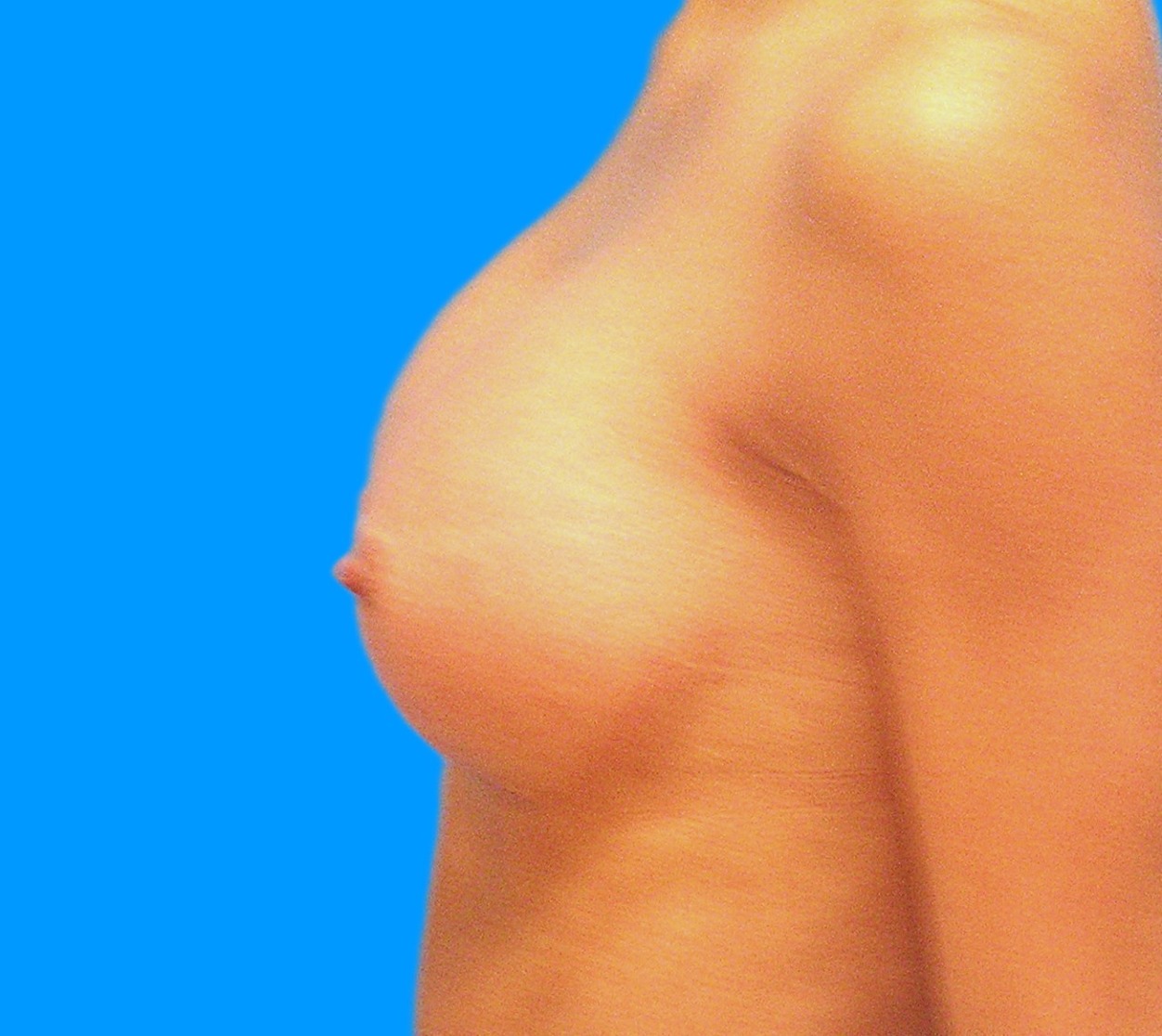 After Image: Patient Case #0179 - left-side