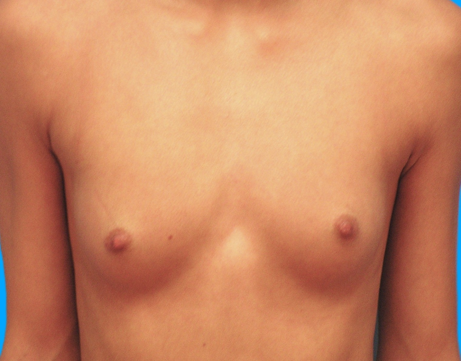 Before Image: Patient Case #0179 - front