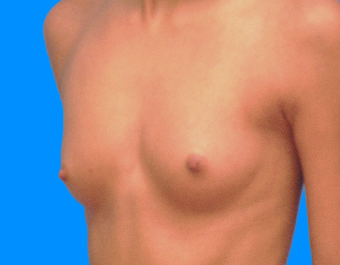 Before Image: Patient Case #0179 - left-front-oblique