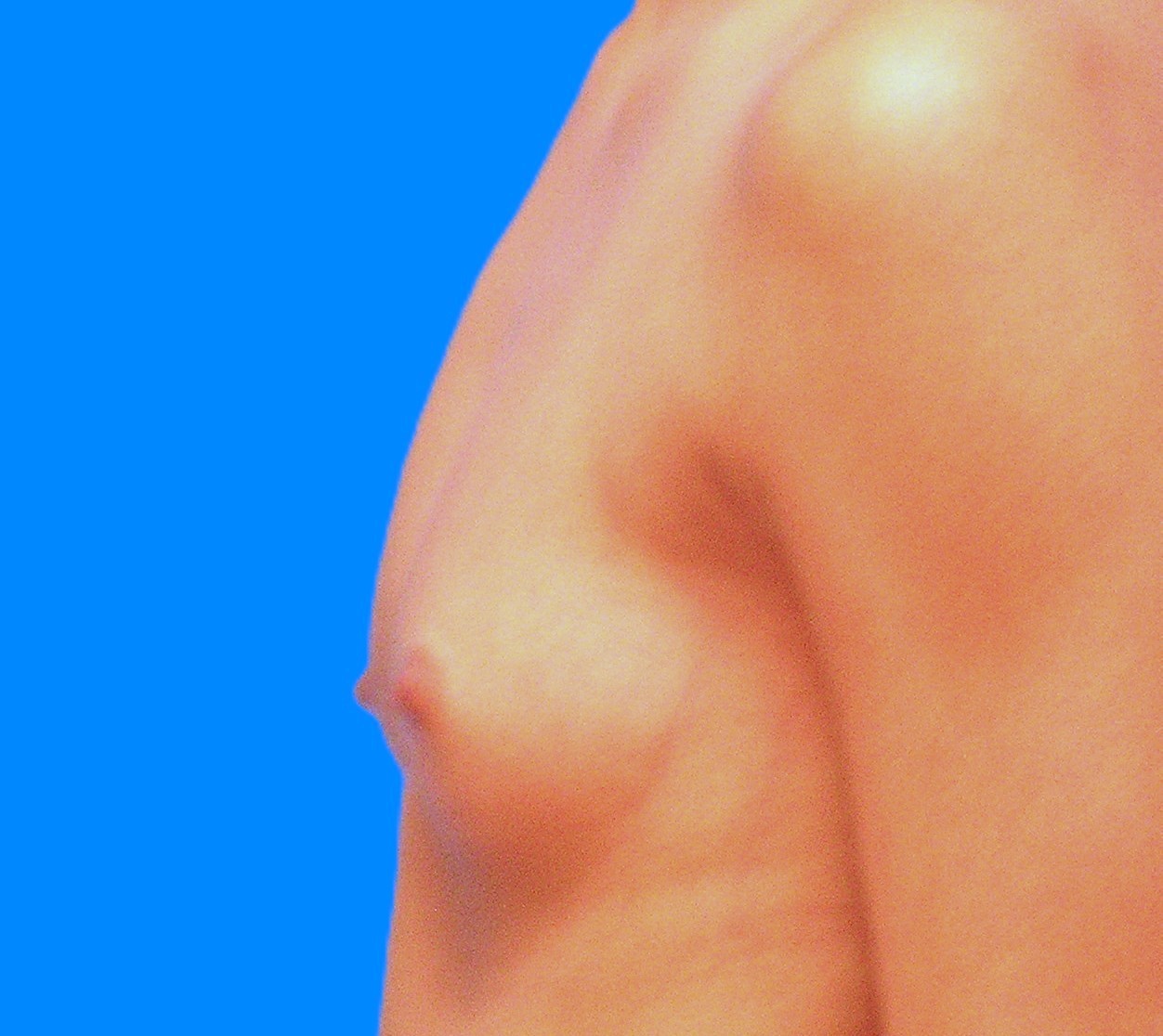 Before Image: Patient Case #0179 - left-side