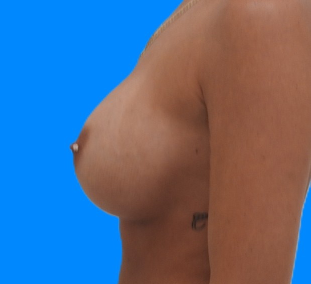 After Image: Patient Case #0180 - left-side