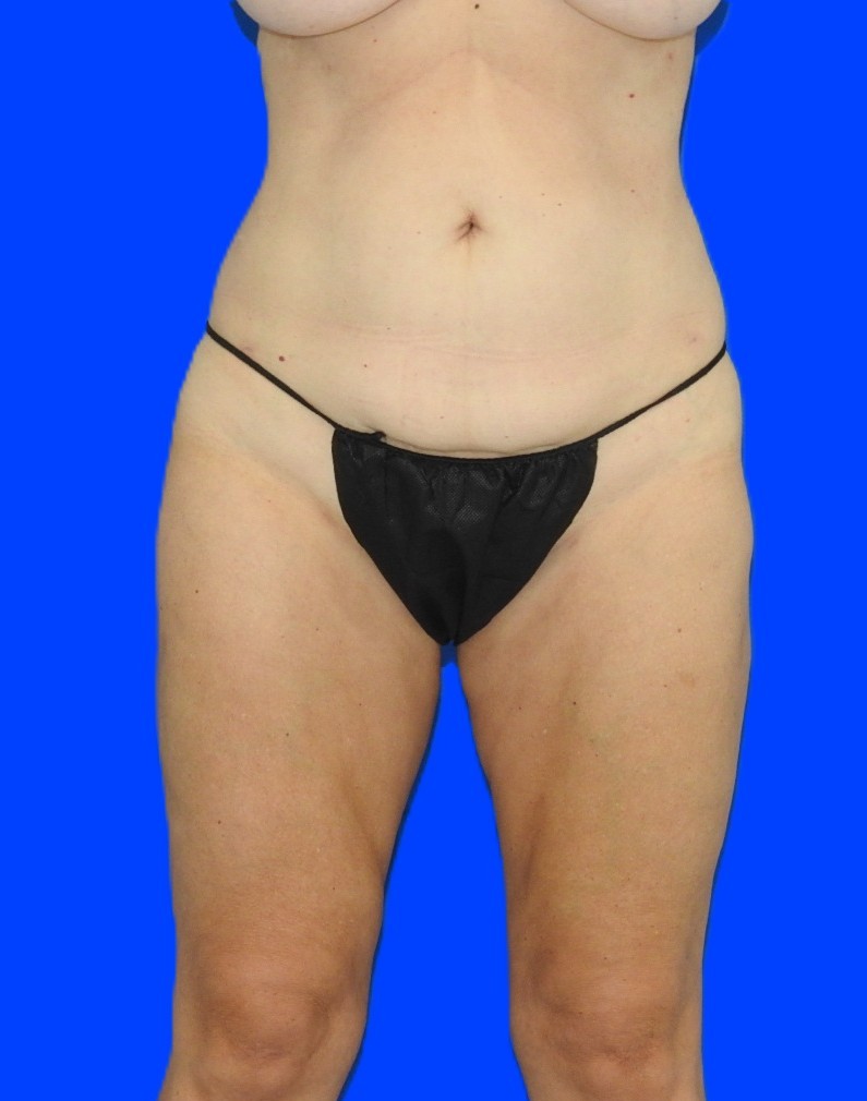 After Image: Patient Case #0183 - front