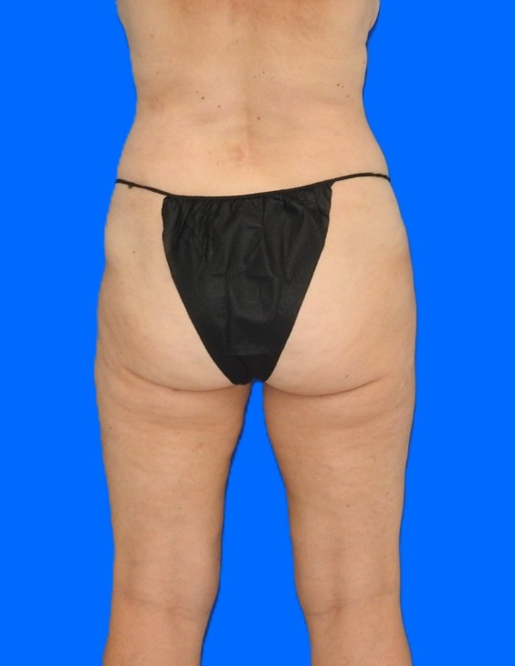 After Image: Patient Case #0183 - back