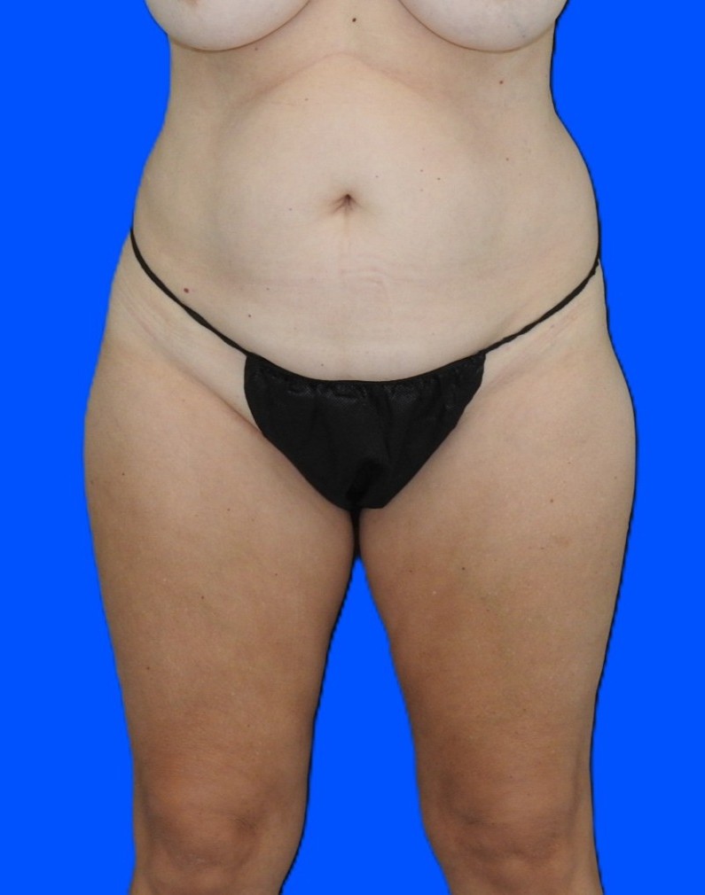 Before Image: Patient Case #0183 - front