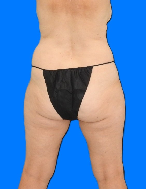 Before Image: Patient Case #0183 - back