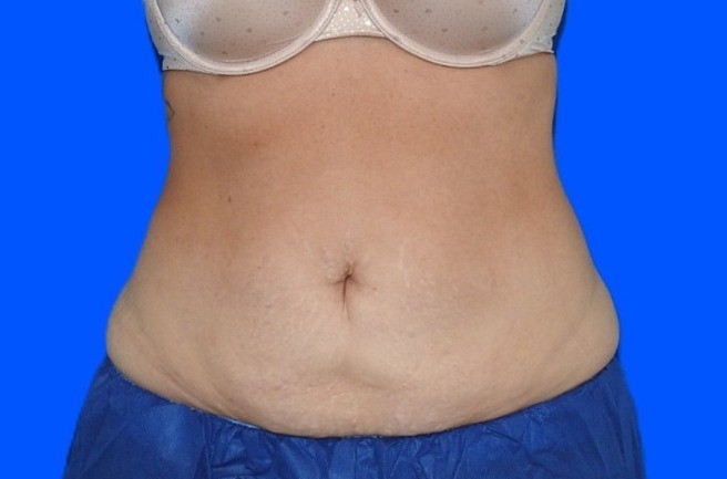 After Image: Patient Case #0184 - front