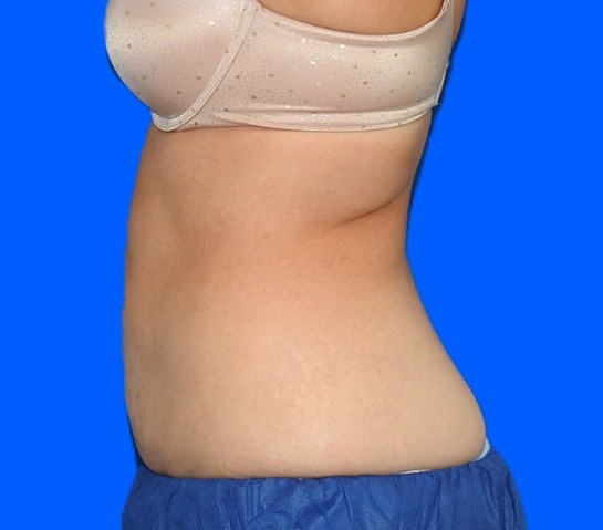 After Image: Patient Case #0184 - left-side