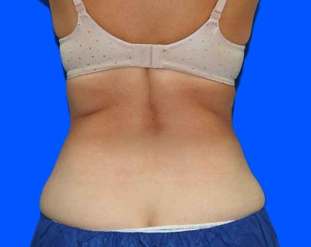 After Image: Patient Case #0184 - back