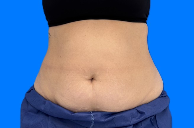 Before Image: Patient Case #0184 - front