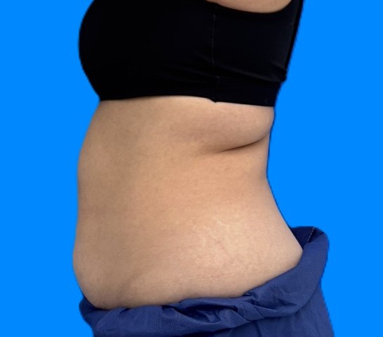 Before Image: Patient Case #0184 - left-side