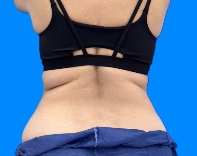 Before Image: Patient Case #0184 - back