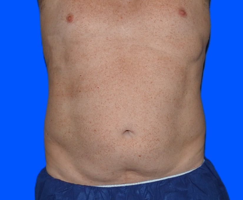 After Image: Patient Case #0185 - front