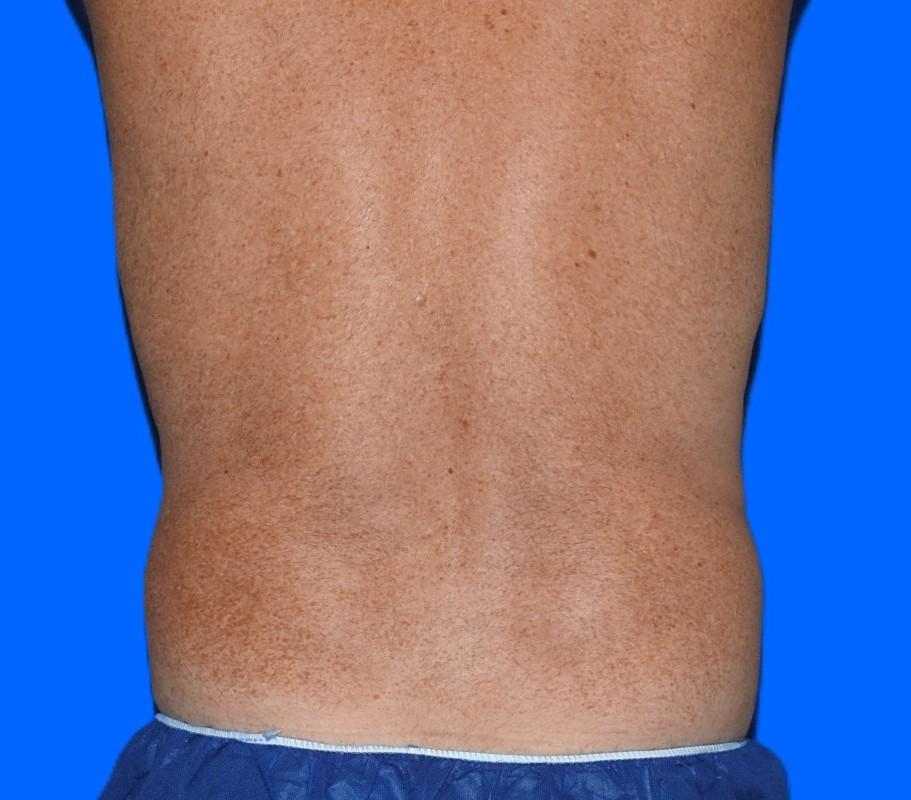 After Image: Patient Case #0185 - back