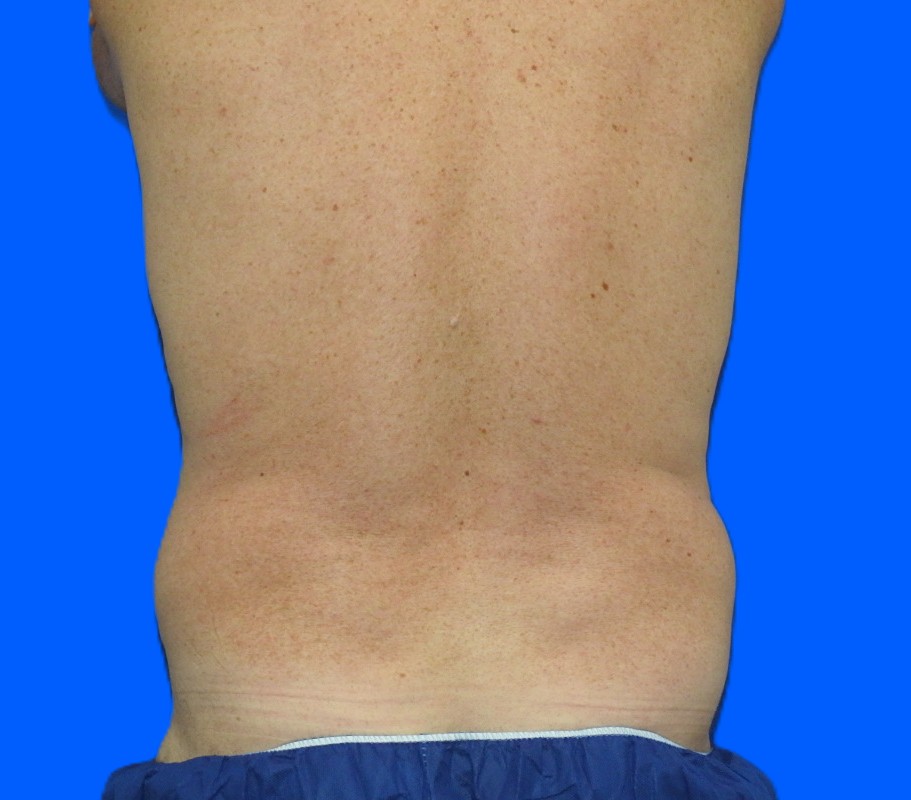 Before Image: Patient Case #0185 - back