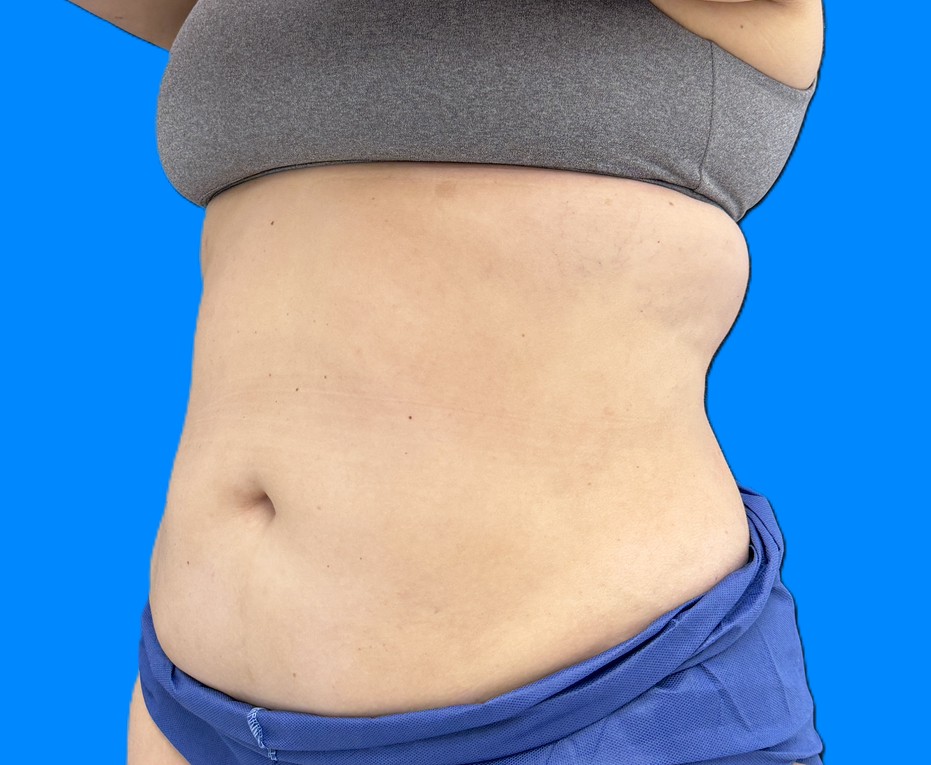 After Image: Patient Case #0186 - left-front-oblique