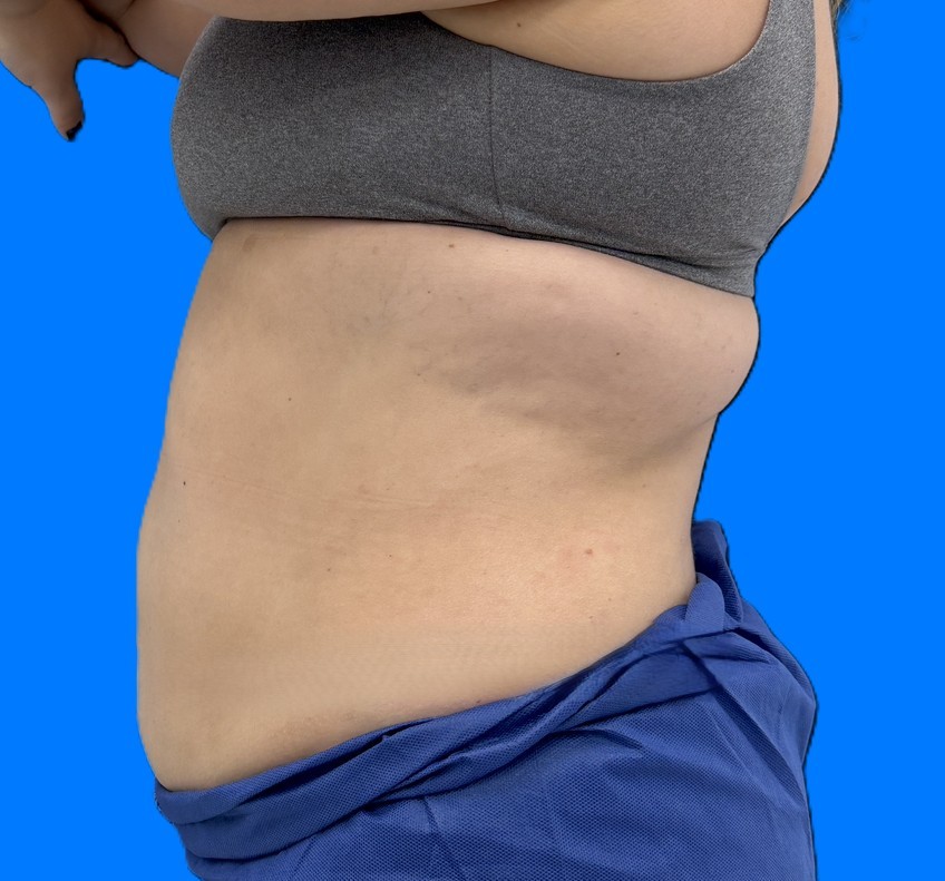 After Image: Patient Case #0186 - left-side