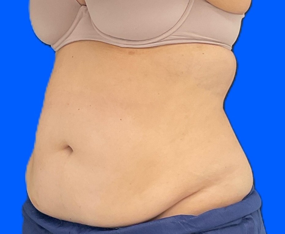 Before Image: Patient Case #0186 - left-front-oblique