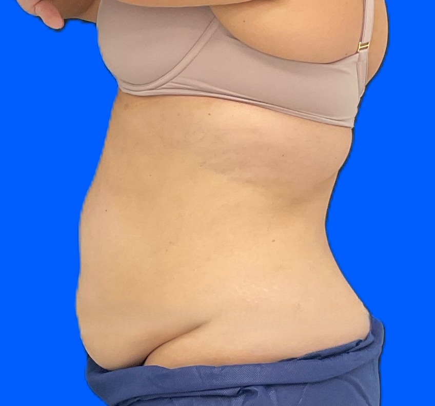 Before Image: Patient Case #0186 - left-side