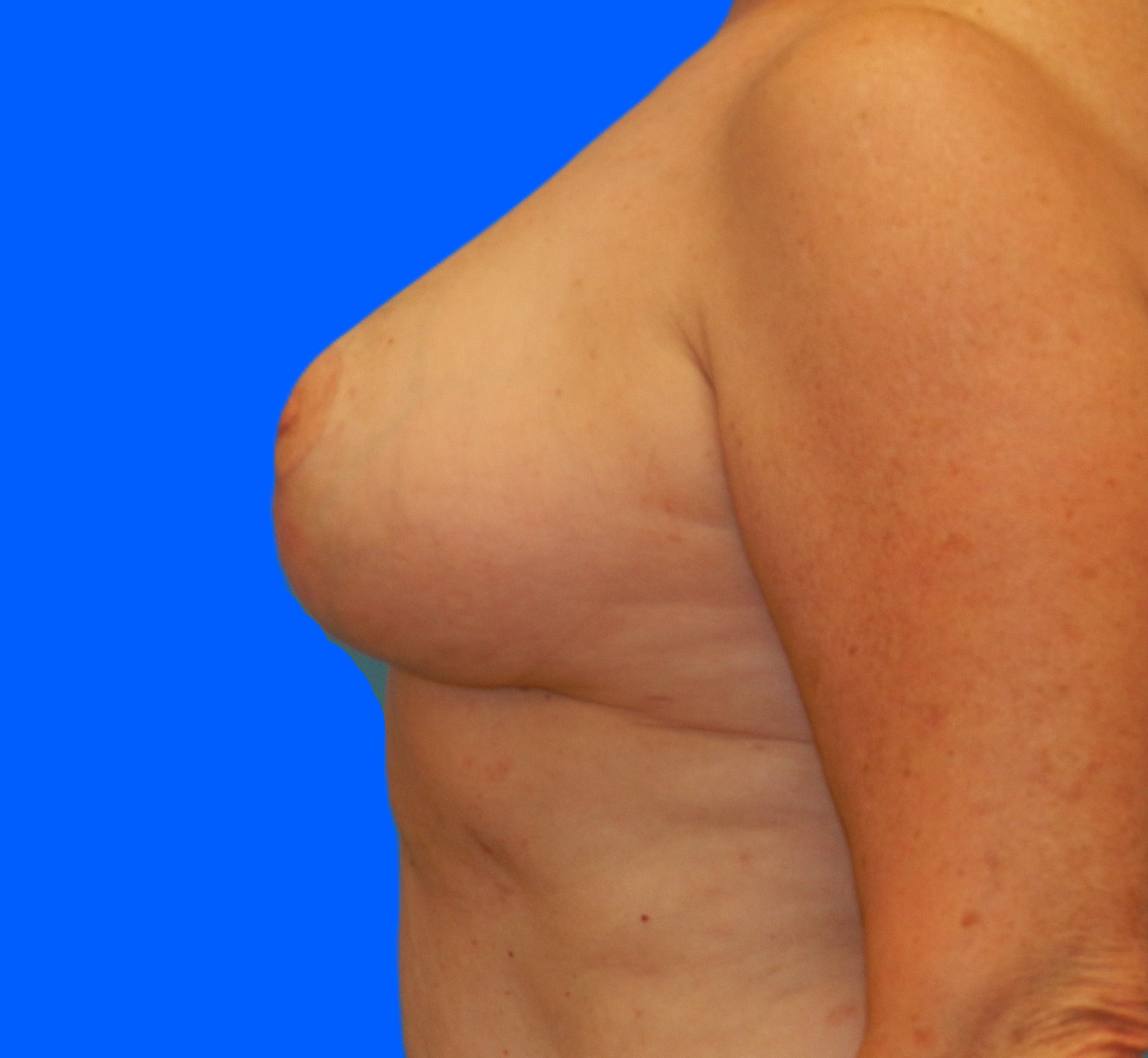 After Image: Patient Case #0187 - left-side