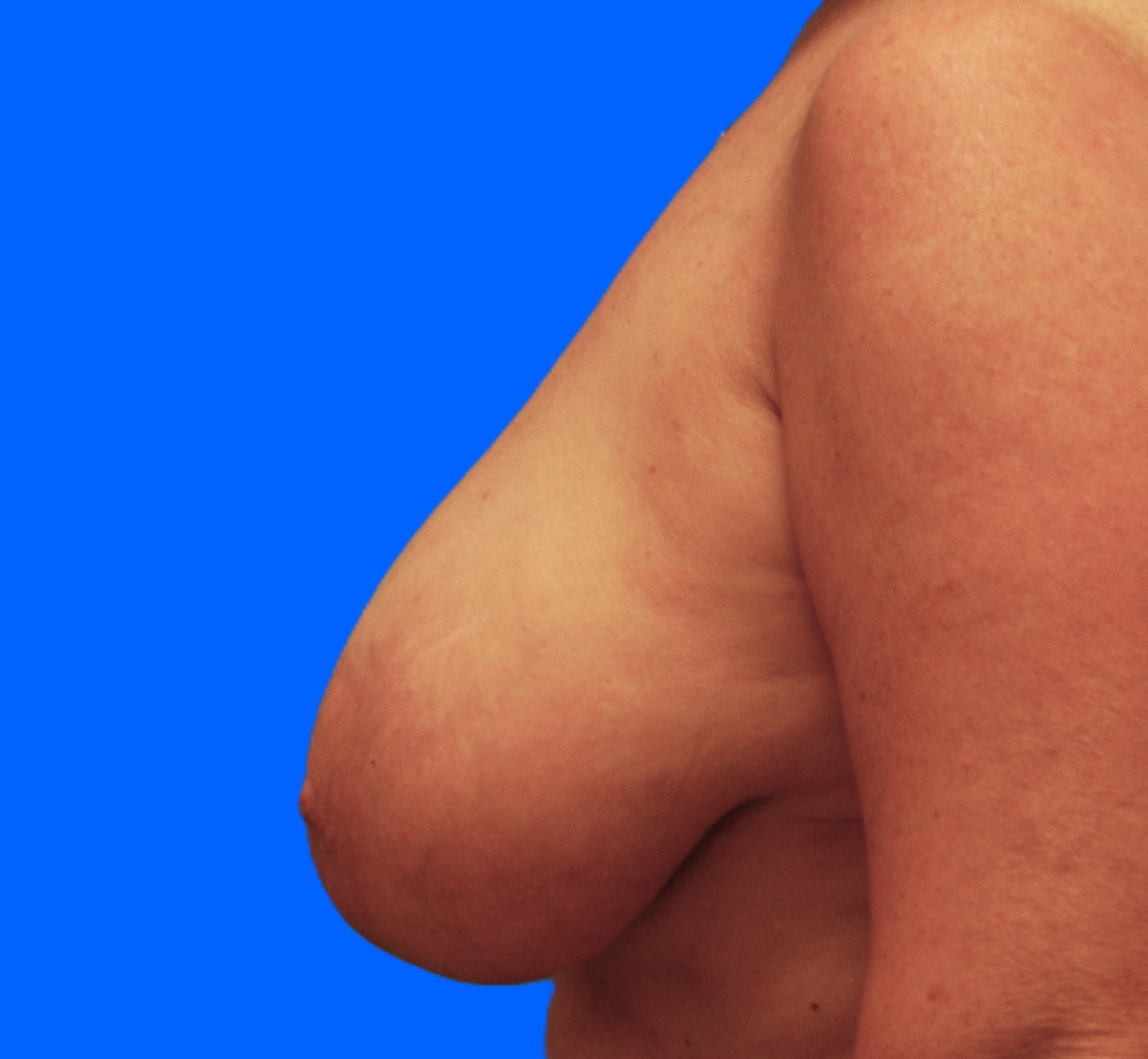 Before Image: Patient Case #0187 - left-side