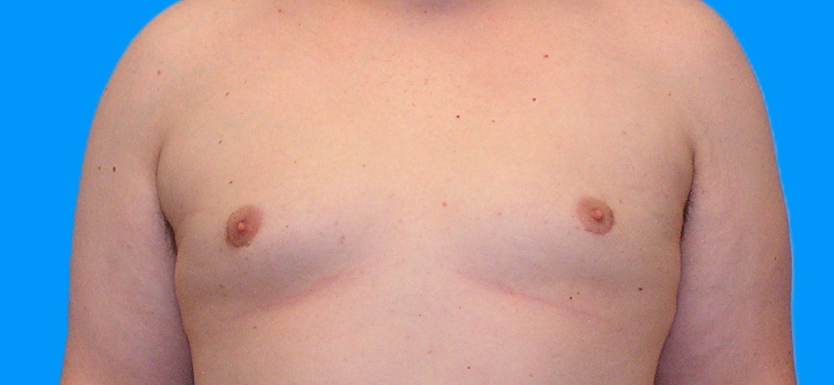 After Image: Patient Case #1022 - front