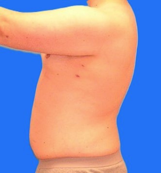 After Image: Patient Case #1022 - left-side