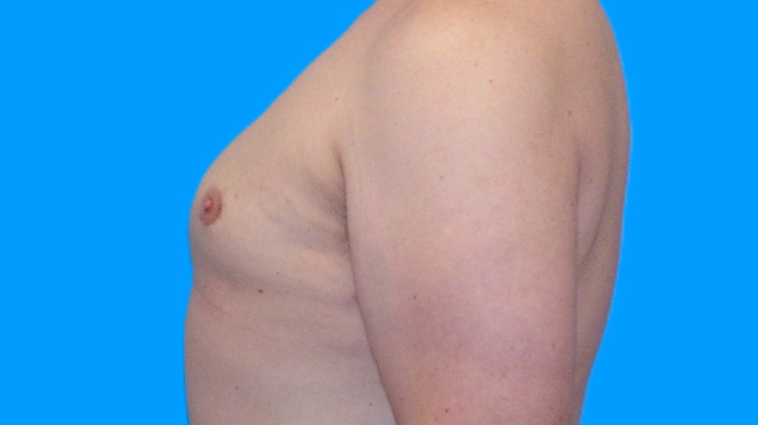 After Image: Patient Case #1022 - left-side