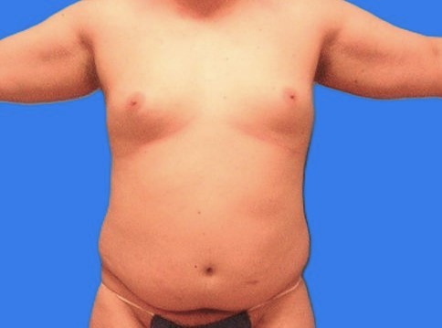 Before Image: Patient Case #1022 - front