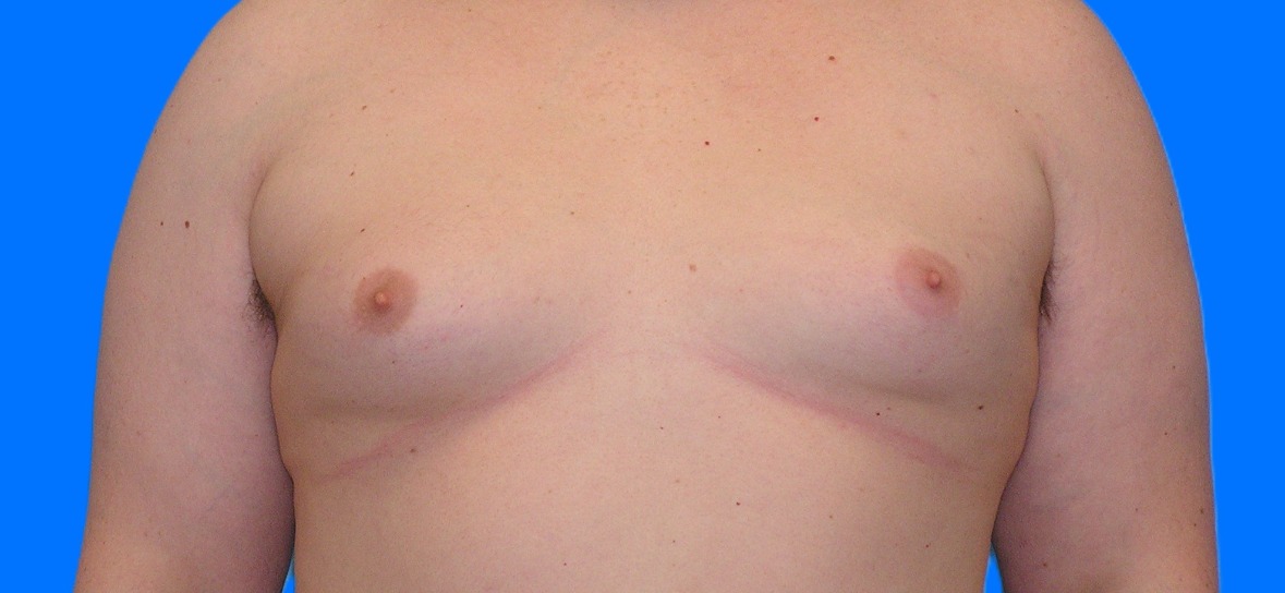 Before Image: Patient Case #1022 - front