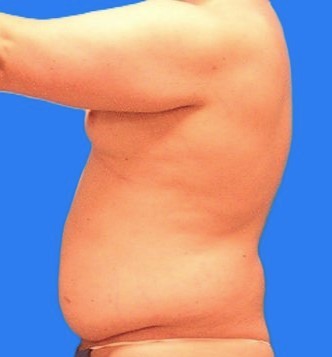 Before Image: Patient Case #1022 - left-side