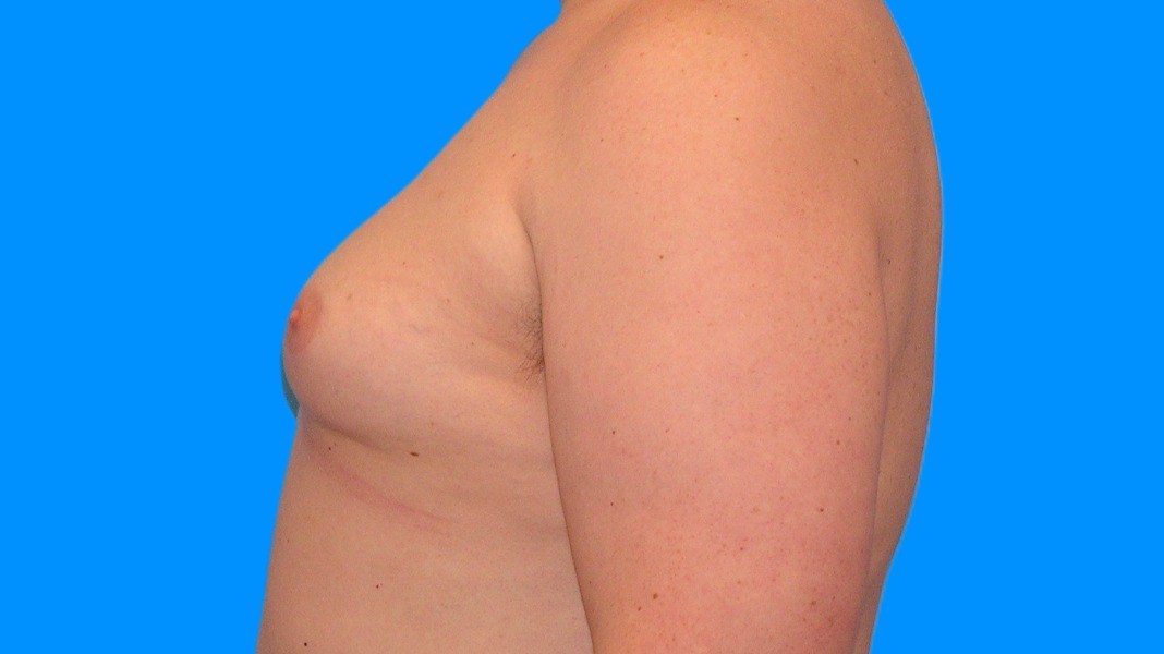 Before Image: Patient Case #1022 - left-side
