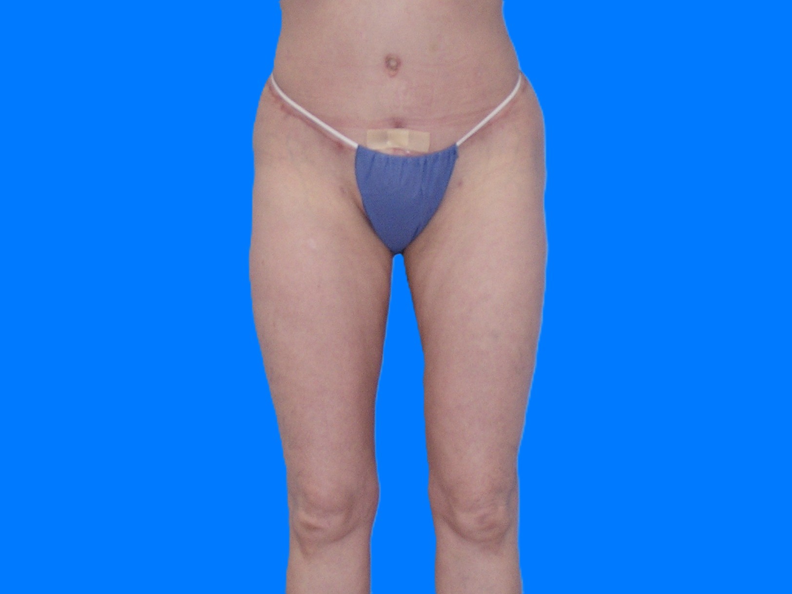 After Image: Patient Case #1054 - front