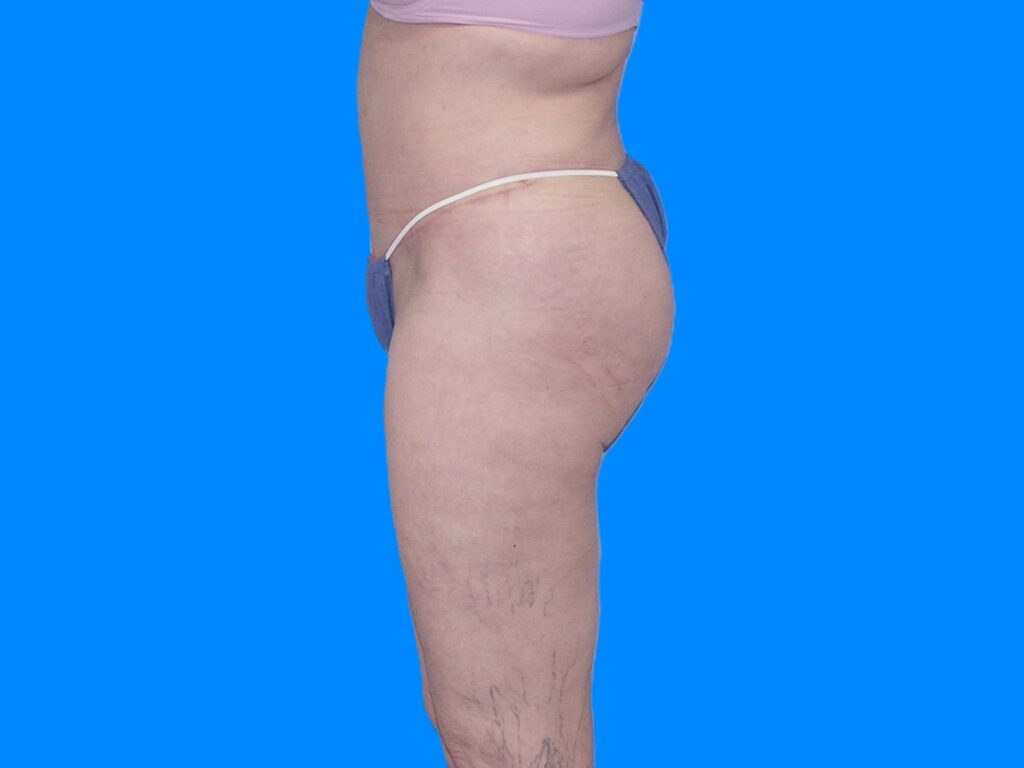 After Image: Patient Case #1054 - left-side