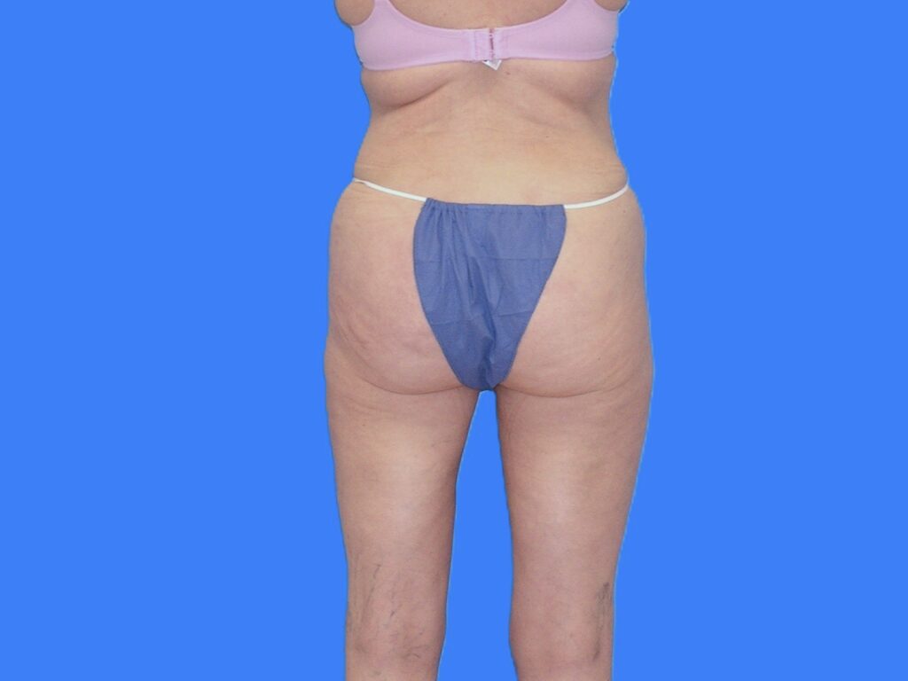 After Image: Patient Case #1054 - back