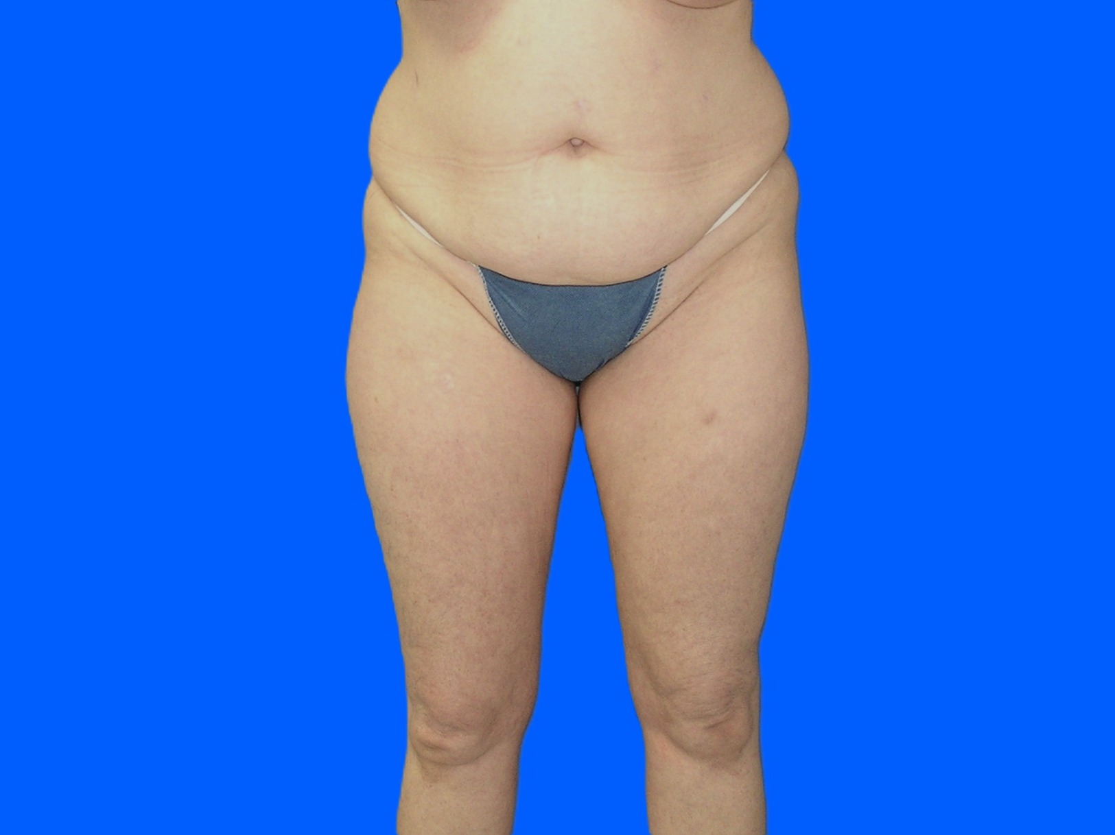 Before Image: Patient Case #1054 - front