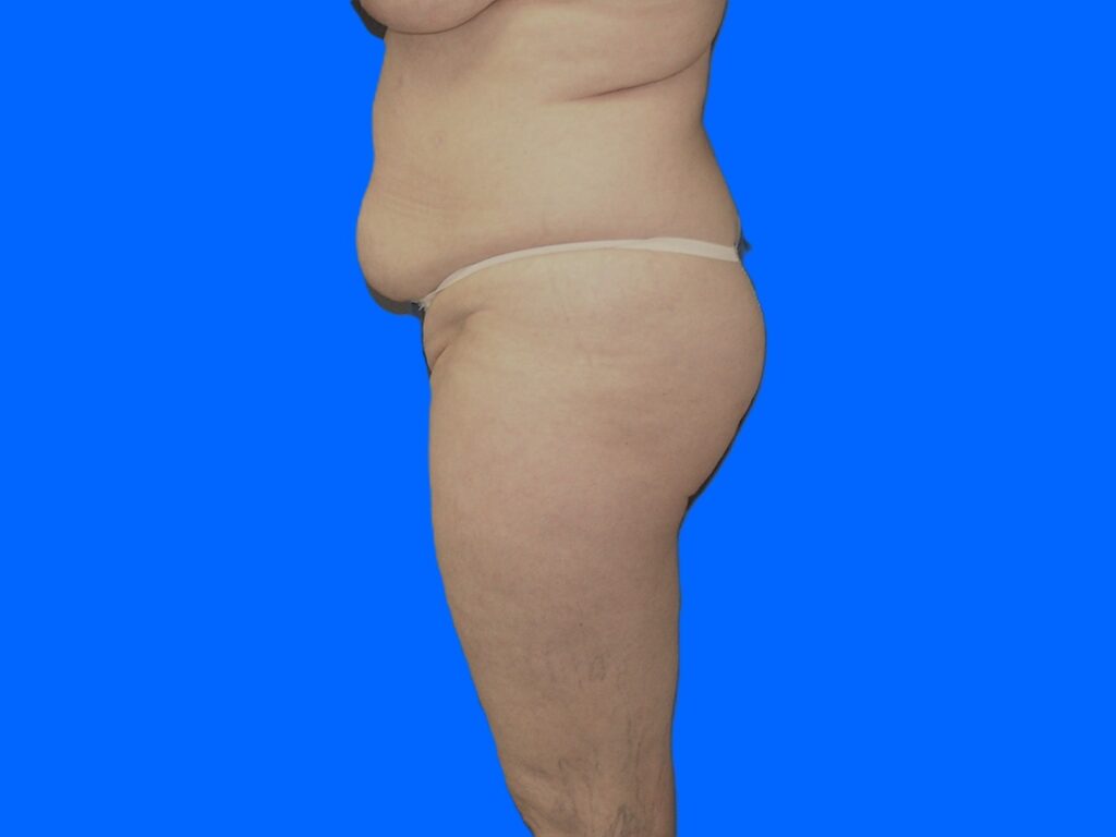 Before Image: Patient Case #1054 - left-side
