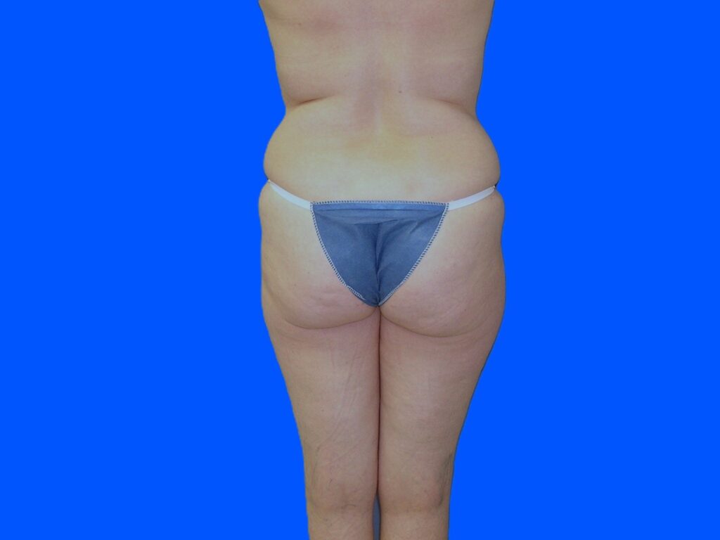 Before Image: Patient Case #1054 - back