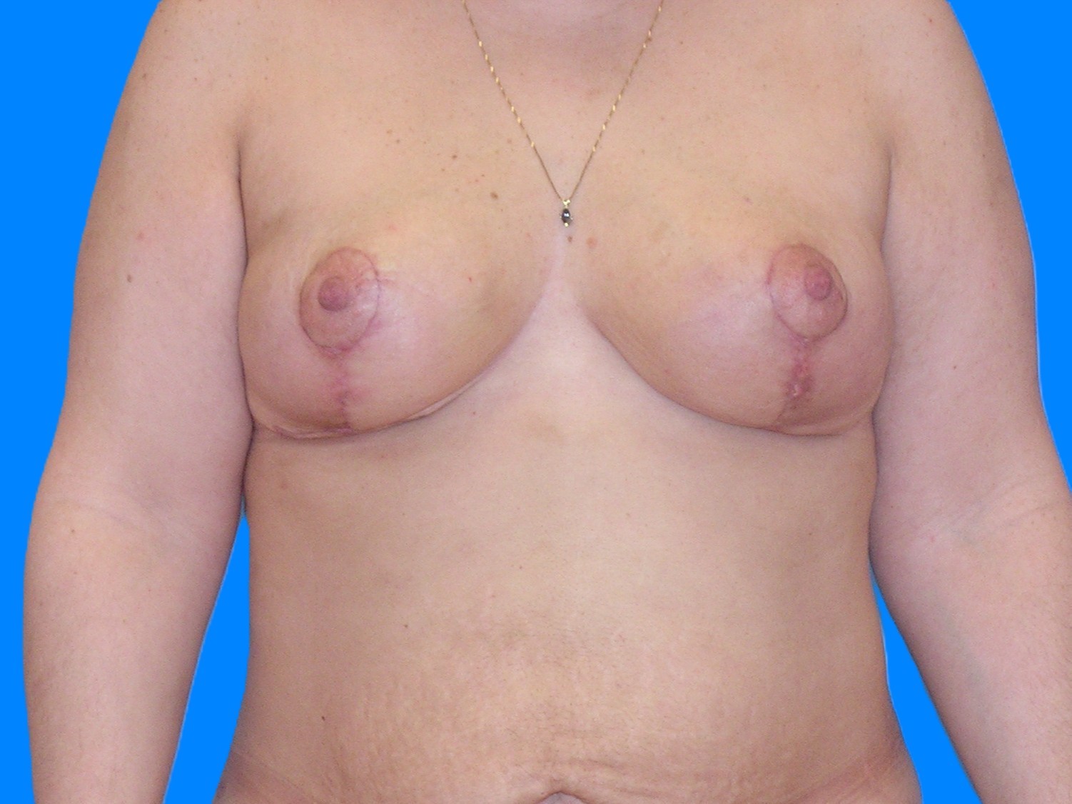 After Image: Patient Case #1055 - front
