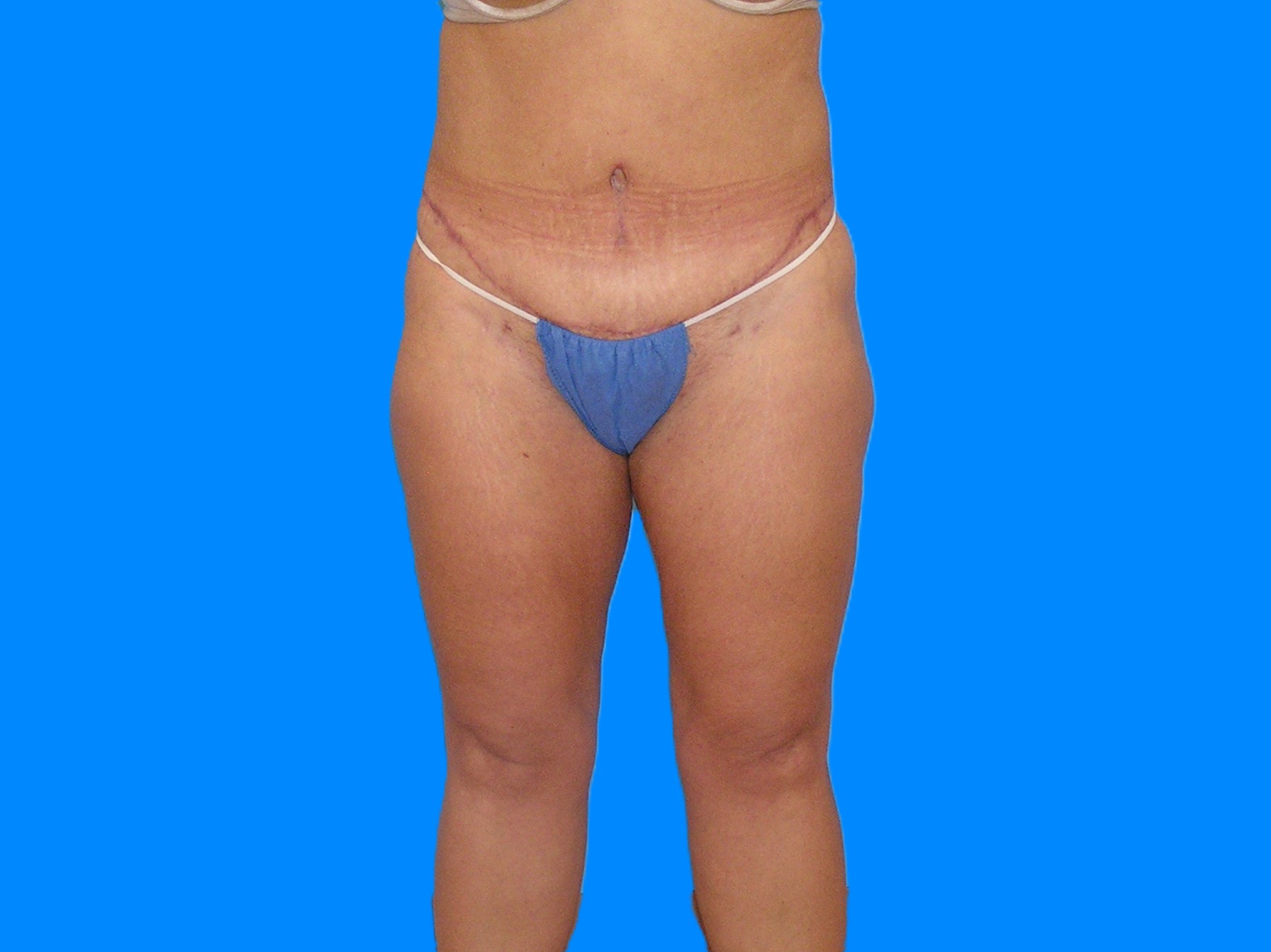 After Image: Patient Case #1055 - front