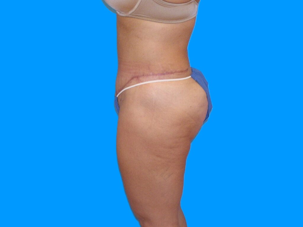 After Image: Patient Case #1055 - left-side