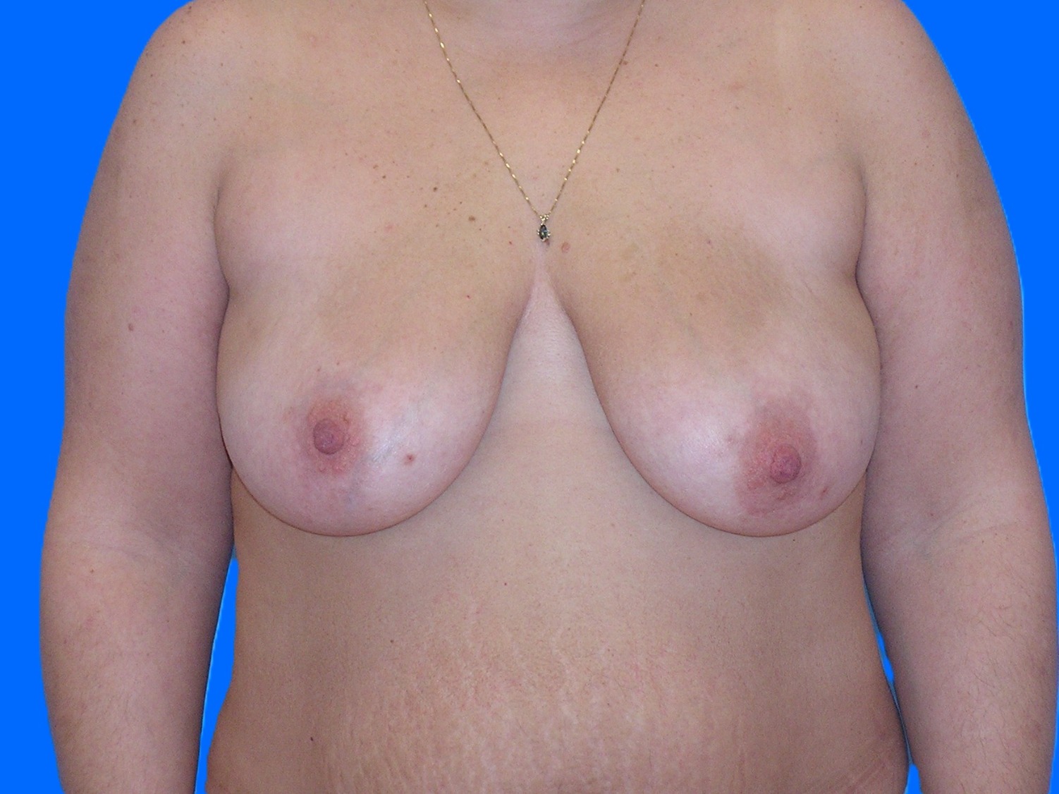 Before Image: Patient Case #1055 - front
