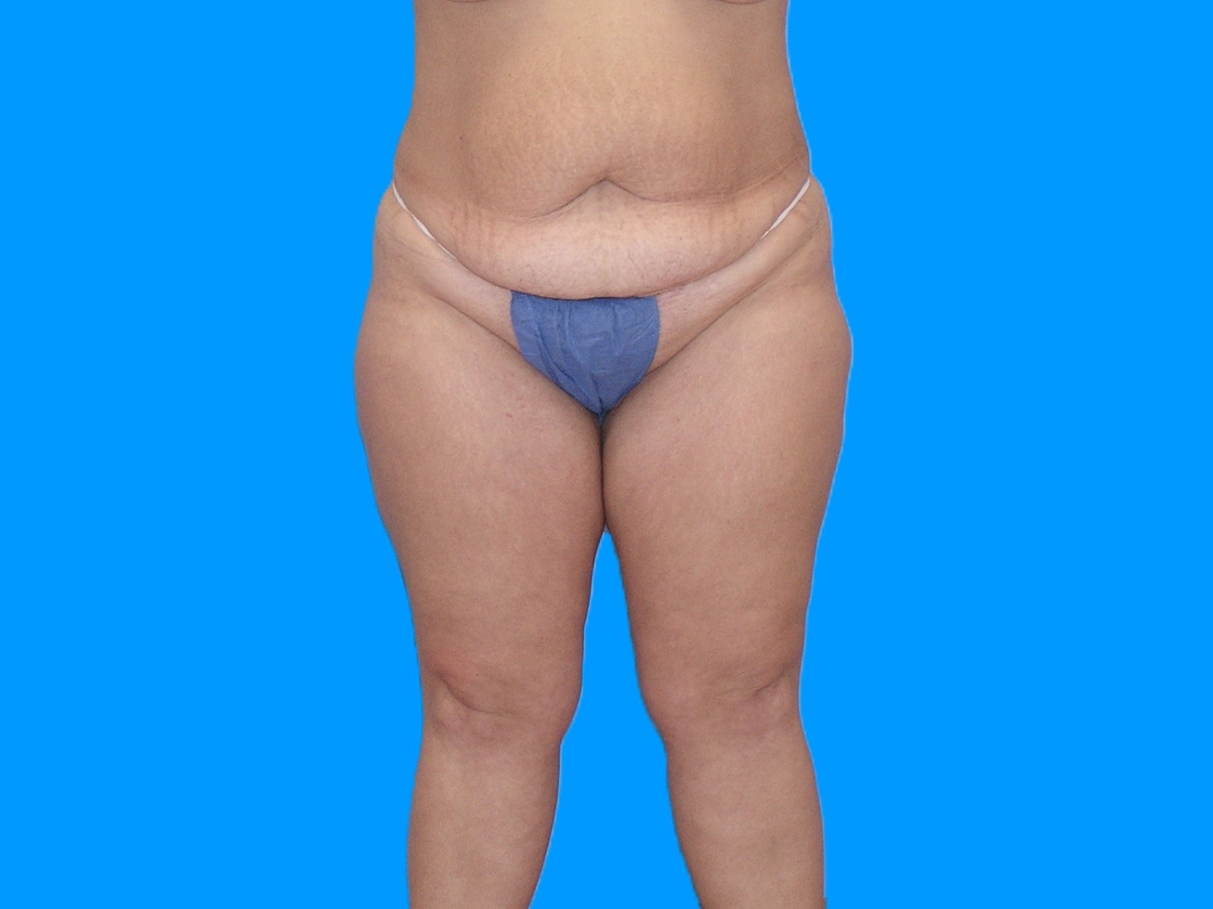 Before Image: Patient Case #1055 - front